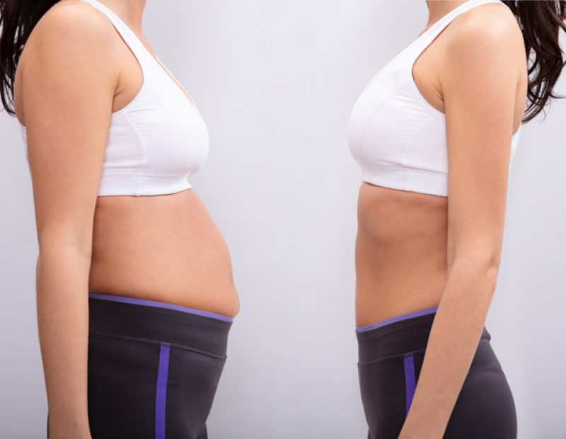 Abdominoplastia: La técnica definitiva de rejuvenecimiento abdominal